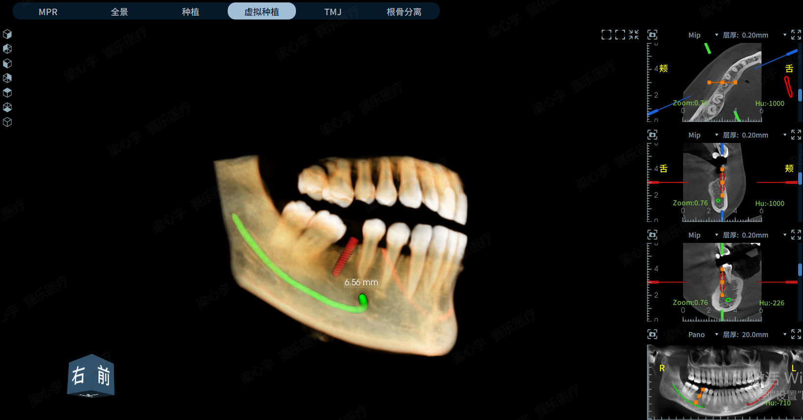 植體-神經(jīng)管碰撞檢測